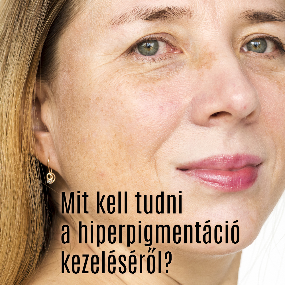 Mit kell tudni a hiperpigmentáció kezeléséről?