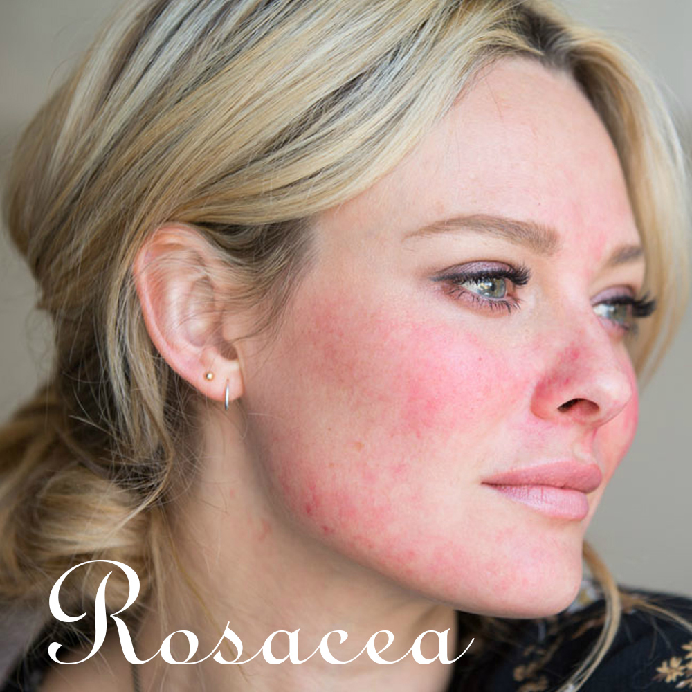 Rosacea: A bőrpír sötét titkai és a varázslatos bőrápolás, amely visszahozza az önbizalmad!